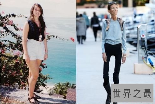 世界上最瘦的人 极其减肥形成体重仅20公斤