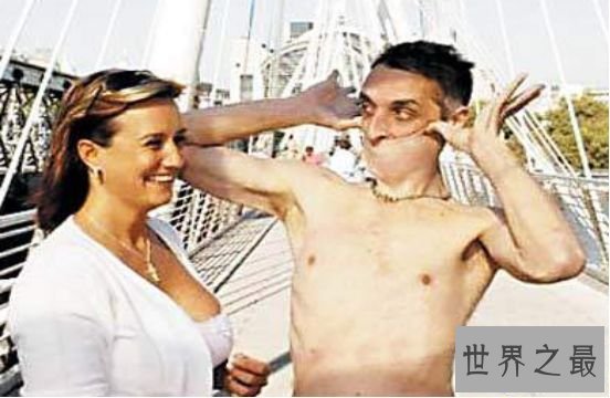 世界上皮肤最有弹性的人 加里.特纳下巴的皮肤能笼罩嘴巴