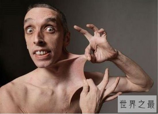 世界上皮肤最有弹性的人 加里.特纳下巴的皮肤能笼罩嘴巴