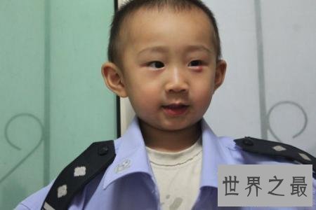 【图】眼睛长了麦粒肿图片 麦粒肿的缘由以及如何处理