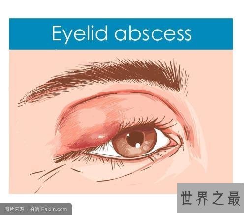 【图】眼睛长了麦粒肿图片 麦粒肿的缘由以及如何处理