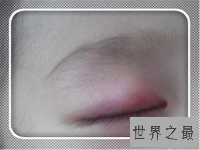 【图】眼睛长了麦粒肿图片 麦粒肿的缘由以及如何处理