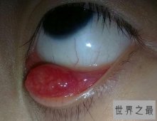 【图】眼睛长了麦粒肿图片 麦粒肿的原因以及如何解决
