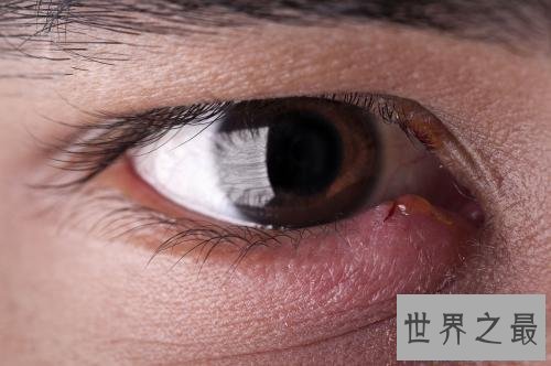 【图】眼睛长了麦粒肿图片 麦粒肿的缘由以及如何处理
