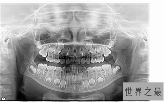 【图】人有多少颗牙齿 8种牙齿不拔出影响身材疾病