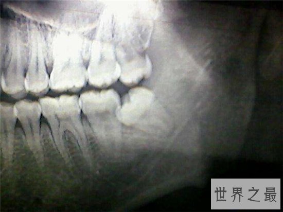 【图】人有多少颗牙齿 8种牙齿不拔出影响身材疾病