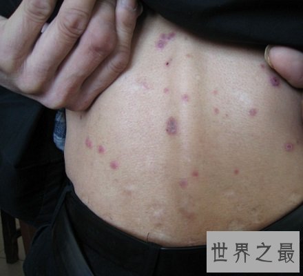 【图】快看看这些梅毒图片 这种性病没有症状长期潜伏