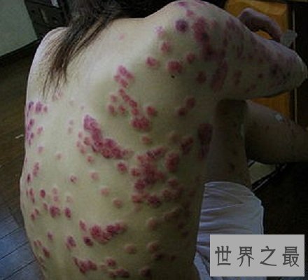 【图】快看看这些梅毒图片 这种性病没有症状长期潜伏