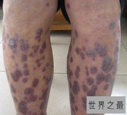 【图】快看看这些梅毒图片 这种性病没有症状长期潜伏