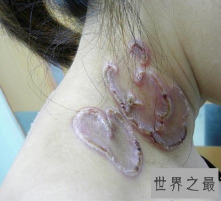 【图】快看看这些梅毒图片 这种性病没有症状长期潜伏