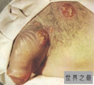 【图】快看看这些梅毒图片 这种性病没有症状长期潜伏