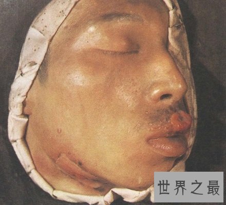 【图】快看看这些梅毒图片 这种性病没有症状长期潜伏