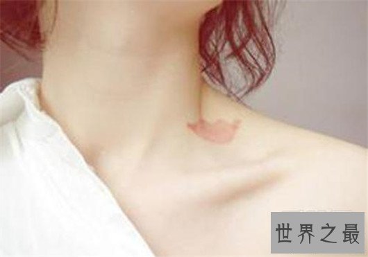 【图】吻痕怎样快速消弭，史上最全的小妙招三分钟解