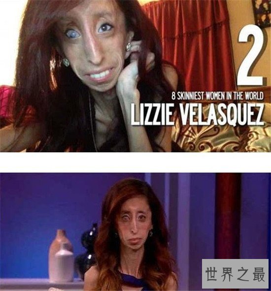 【图】世界上最瘦的人 不要盲目节食减肥损伤身材