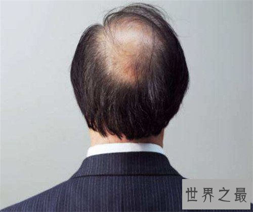 【图】掉头发是什么缘由 女生头发稀少应该怎样办