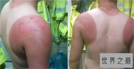 【图】晒伤后怎样解决 简略的家用小窍门来处理