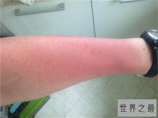 【图】晒伤后怎样解决 简略的家用小窍门来处理