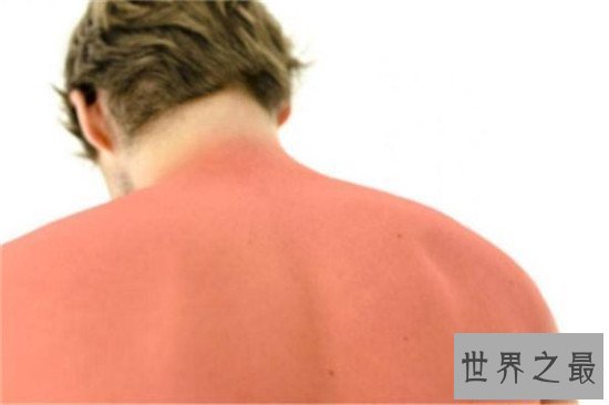 【图】晒伤后怎样解决 简略的家用小窍门来处理