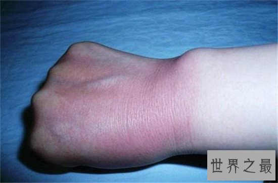 【图】晒伤后怎样解决 简略的家用小窍门来处理