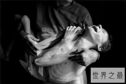 【图】核辐射对人体的危害 怎么预防和治愈核辐射