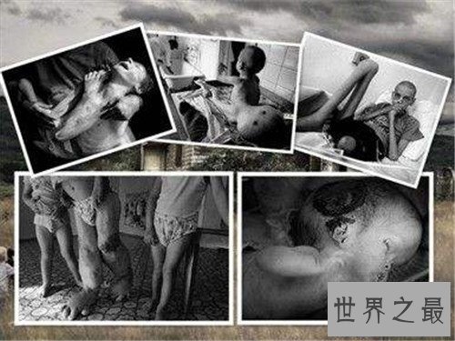 【图】核辐射对人体的危害 怎么预防和治愈核辐射