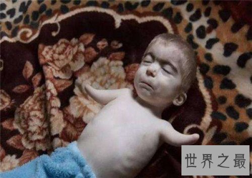 【图】核辐射对人体的危害 怎么预防和治愈核辐射