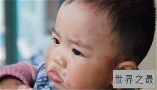 【图】水痘的症状和治疗 长水痘要留意什么事项