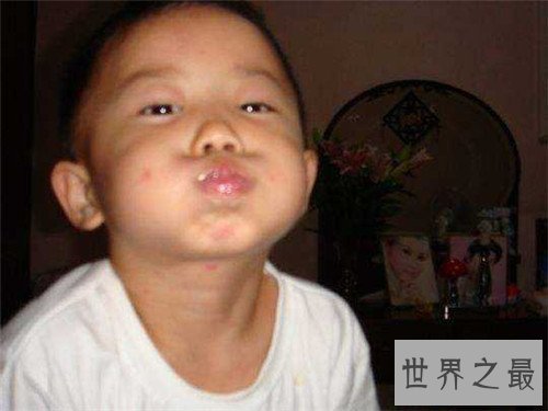 【图】水痘的症状和治疗 长水痘要留意什么事项