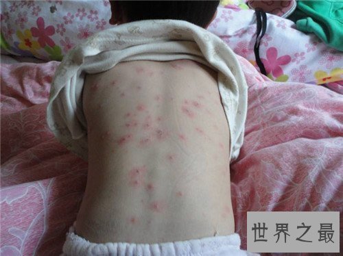 【图】水痘的症状和治疗 长水痘要留意什么事项