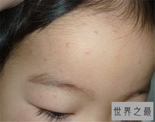【图】水痘的症状和治疗 长水痘要留意什么事项