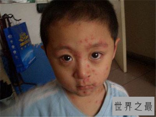 【图】水痘的症状和治疗 长水痘要留意什么事项