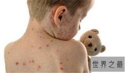 【图】水痘的症状和治疗 长水痘要注意什么事项