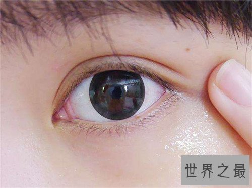 【图】脂肪粒怎样去除 脂肪粒的产生和眼酸有着很大关