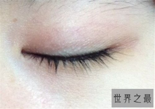 【图】脂肪粒怎样去除 脂肪粒的产生和眼酸有着很大关