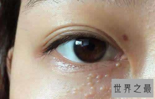 【图】脂肪粒怎样去除 脂肪粒的产生和眼酸有着很大关