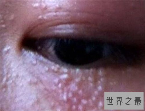 【图】脂肪粒怎样去除 脂肪粒的产生和眼酸有着很大关