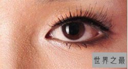 【图】脂肪粒怎么去除 脂肪粒的产生和眼酸有着很大关