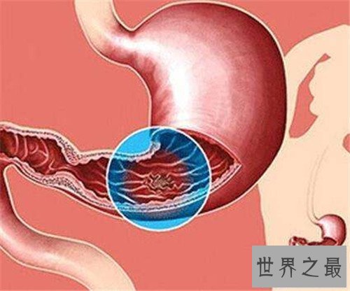 【图】胃癌的早期症状是什么 怎么治疗胃癌有效果
