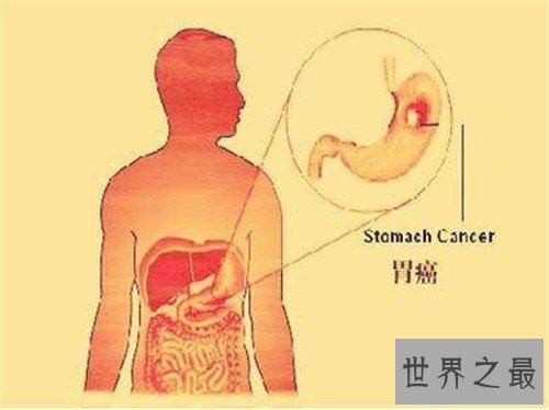 【图】胃癌的早期症状是什么 怎么治疗胃癌有效果