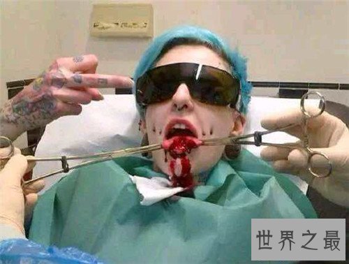 【图】分舌手术的危害及作用 为什么有人会青睐分舌手