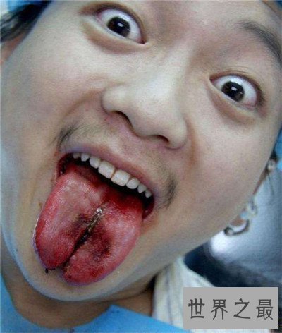 【图】分舌手术的危害及作用 为什么有人会青睐分舌手