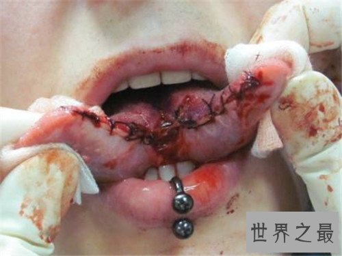 【图】分舌手术的危害及作用 为什么有人会青睐分舌手