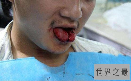 【图】分舌手术的危害及作用 为什么有人会青睐分舌手