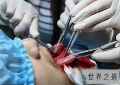 【图】分舌手术的危害及作用 为什么有人会喜欢分舌手