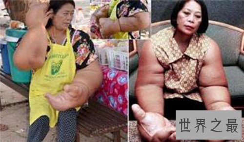 【图】螃蟹手系天生畸形形成 曾有女子听信偏方导致螃