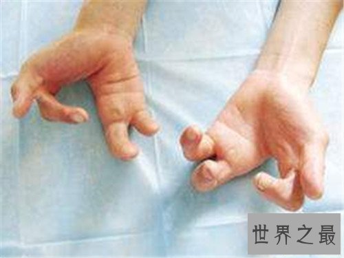 【图】螃蟹手系天生畸形形成 曾有女子听信偏方导致螃