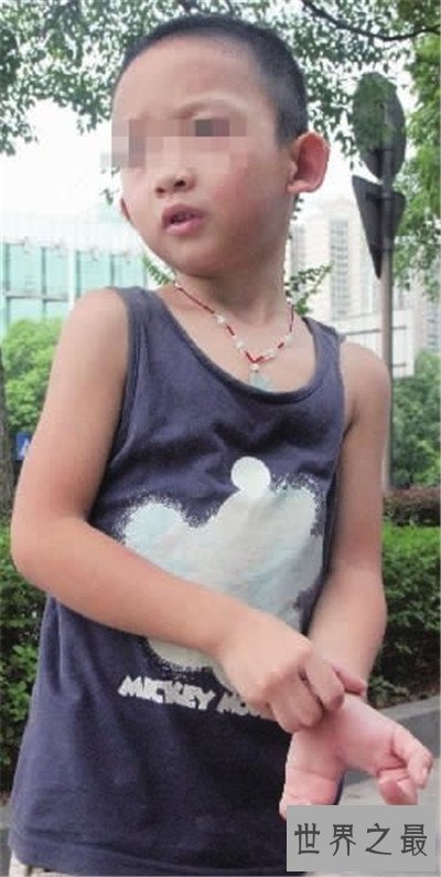 【图】螃蟹手系天生畸形形成 曾有女子听信偏方导致螃