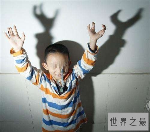 【图】螃蟹手系天生畸形形成 曾有女子听信偏方导致螃