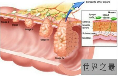 【图】结肠癌晚期症状是谁么样子的呢