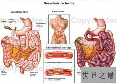 【图】结肠癌晚期症状是谁么样子的呢